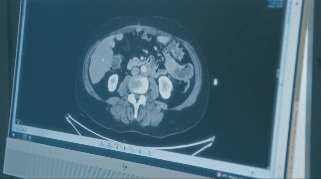 Imagen de un TAC abdominal utilizado en el diagnóstico y seguimiento del cáncer peritoneal